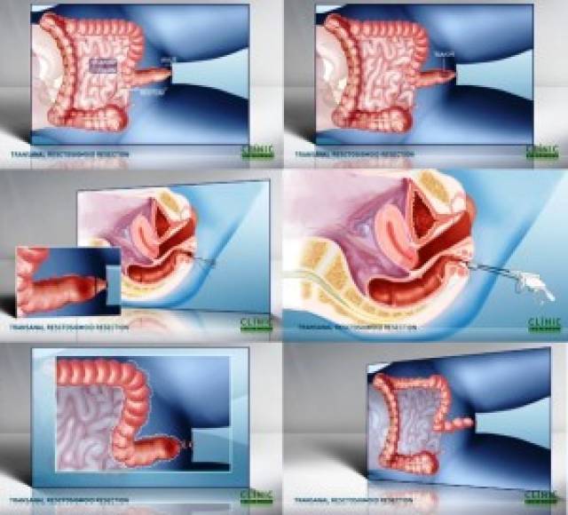 infography rectal mass extraction through the anus