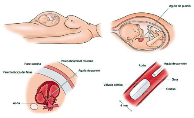 20110728operaciofetal_2_cat