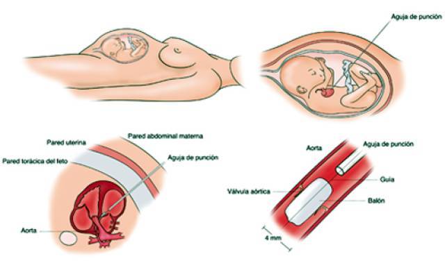 20110728operaciofetal_2_cas