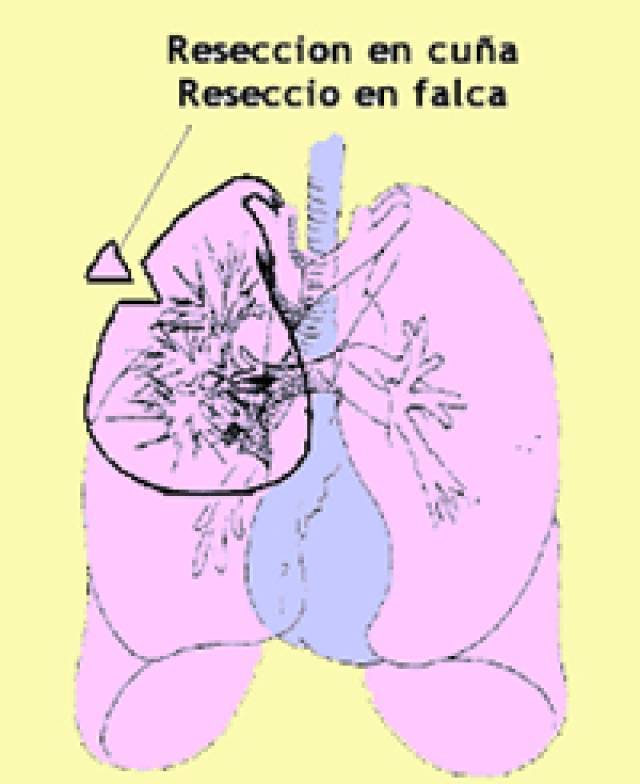 toracotomía con resección en cuña