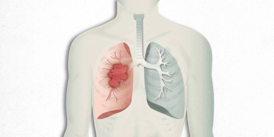 Cáncer de pulmón