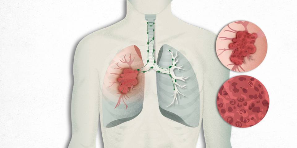 Non-small cell lung cancer