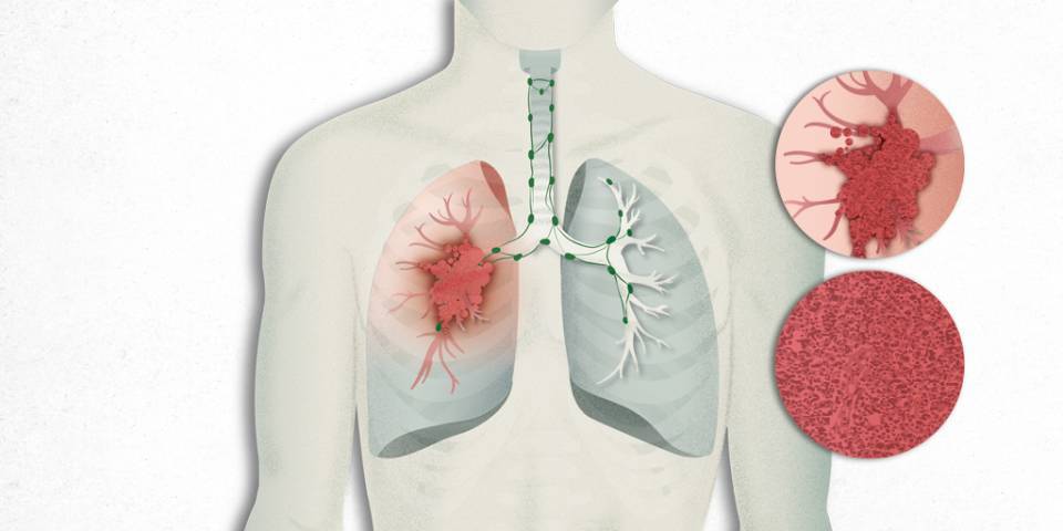 Carcinoma cèl·lules petites