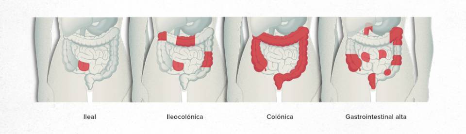 Zonas afectadas enfermedad de Crohn