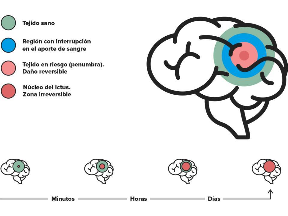 codigo ictus, daño cerebral ictus