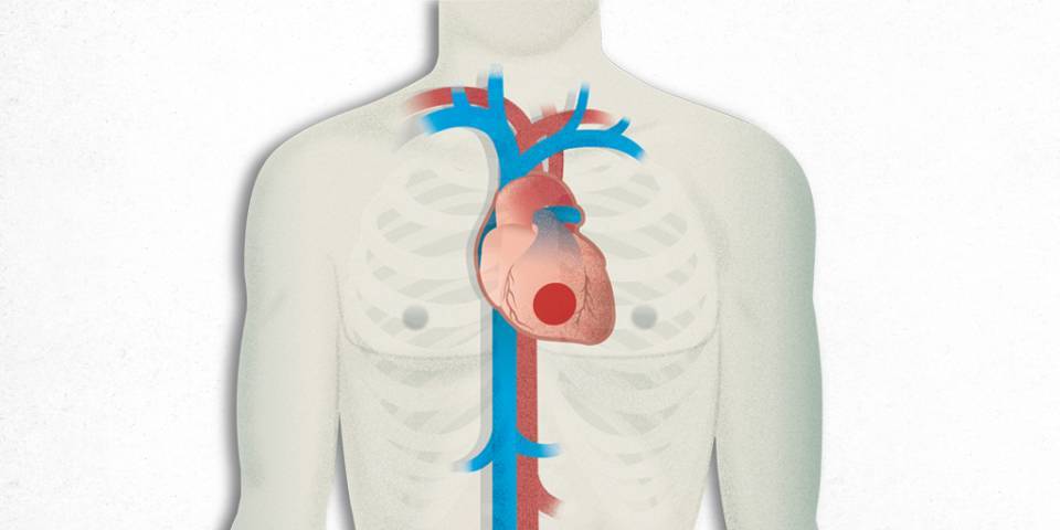 Cardiopatía Isquémica, Infarto, Angina de pecho