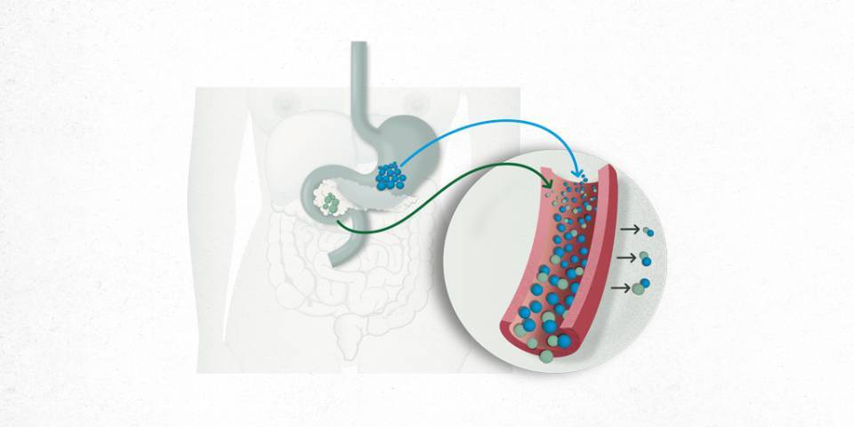 ¿Qué es la Diabetes Tipo 1?
