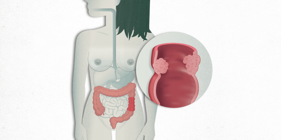 Cáncer de colon y recto (cáncer colorrectal)
