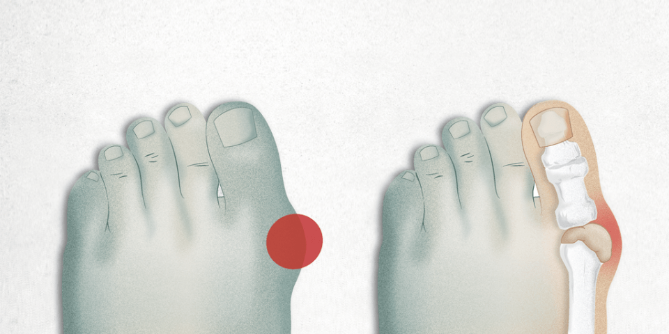 bunion