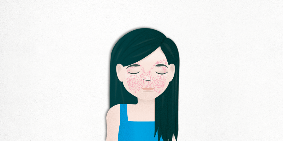 ¿qué es el lupus?