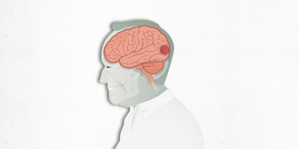 tumor cerebral