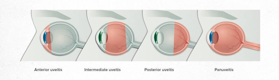 types of uveitis