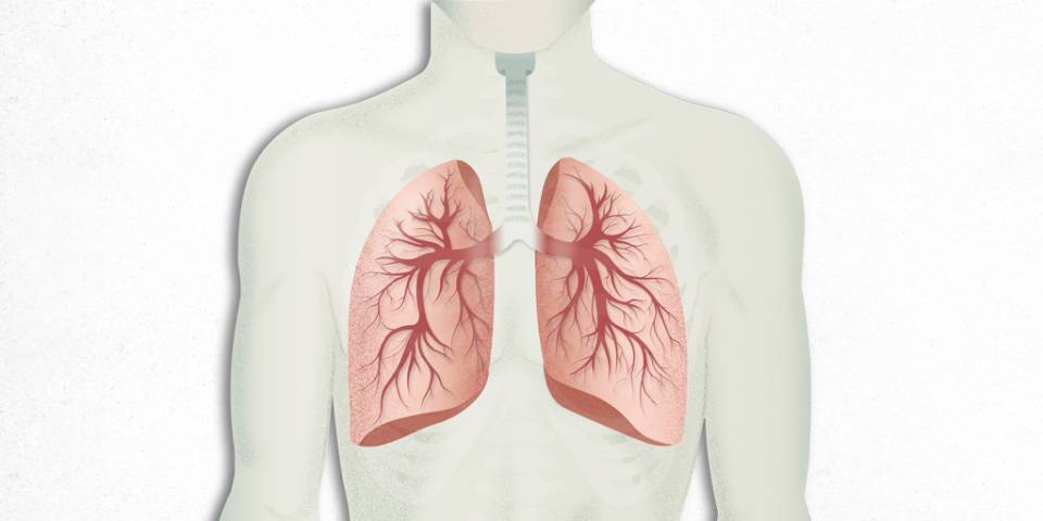 EPOC - Enfermedad Pulmonar Obstructiva