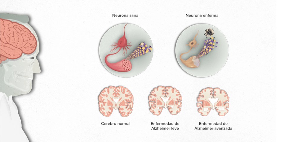 Enfermedad de Alzheimer