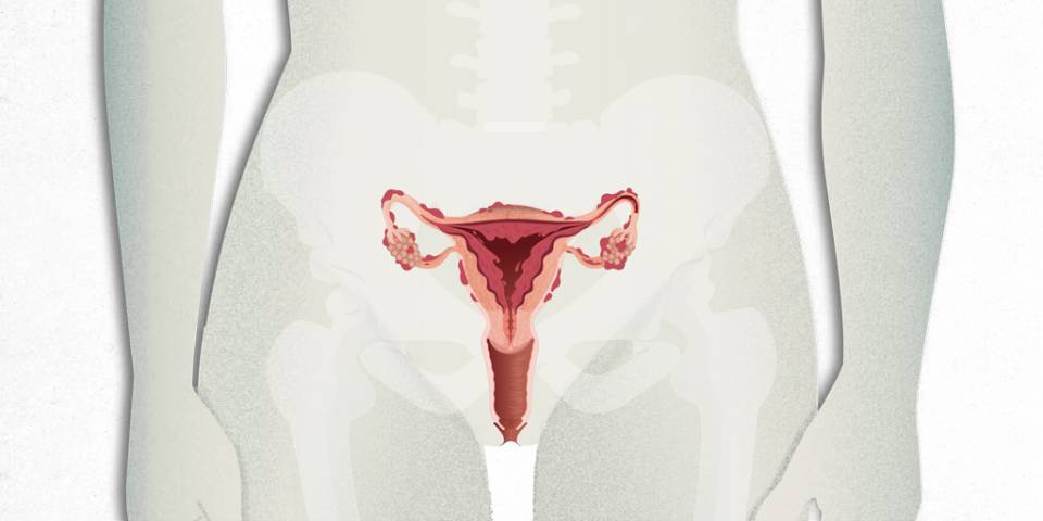 endometriosis