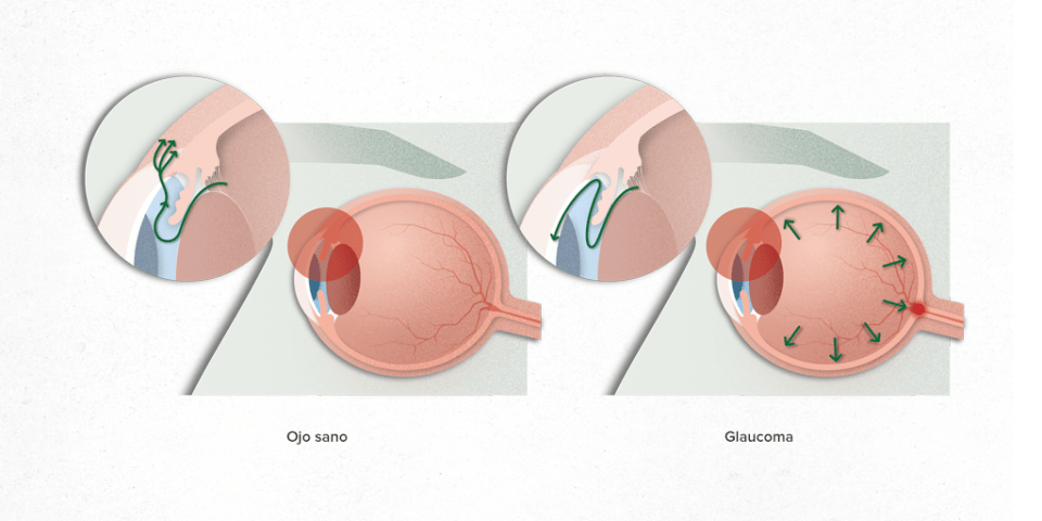 glaucoma