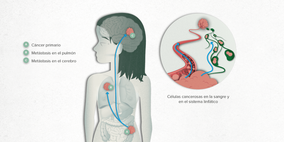 tipos de cáncer