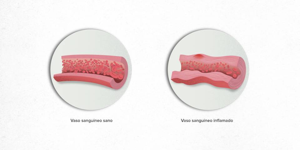Vasculitis