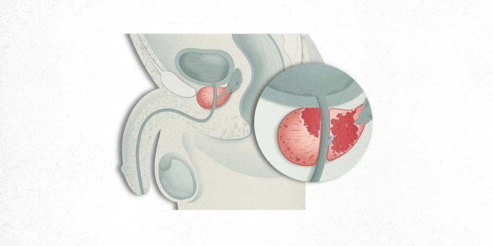 Cáncer de próstata | Cáncer prostático