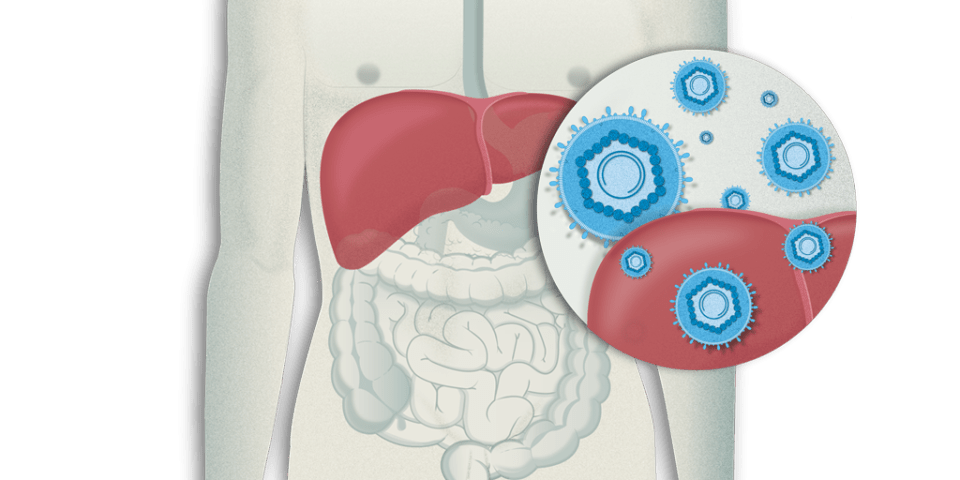 Hepatitis vírica - Hepatitis A B C D