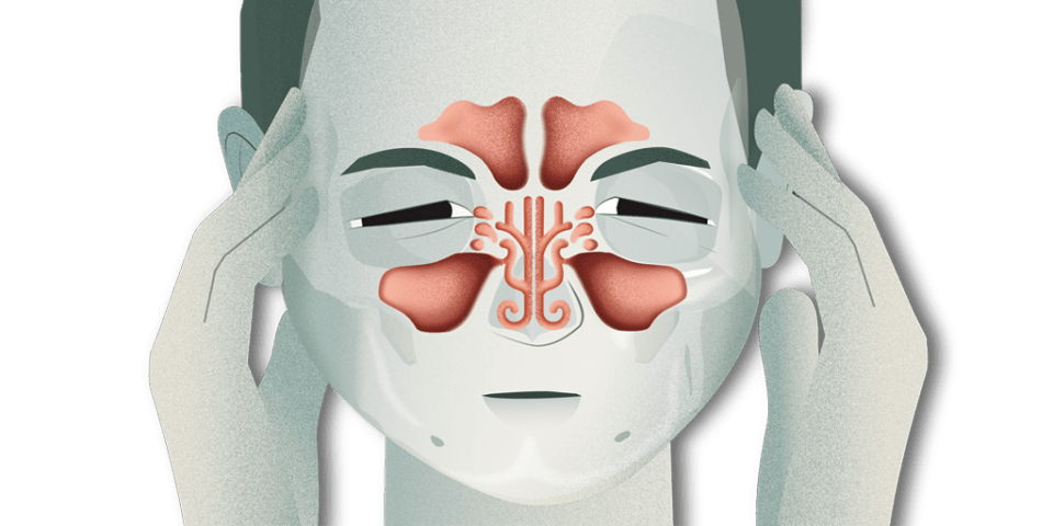 sinusitis