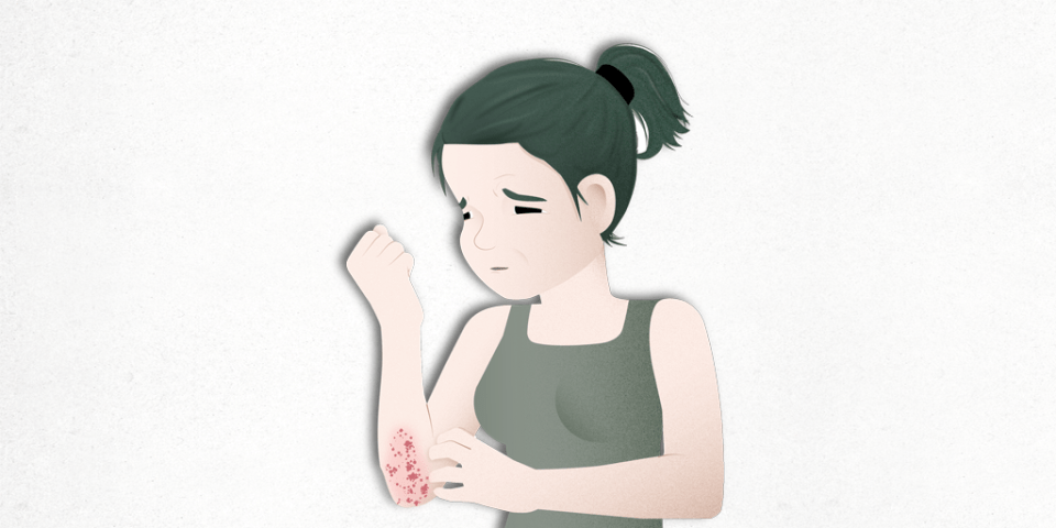 psoriasis