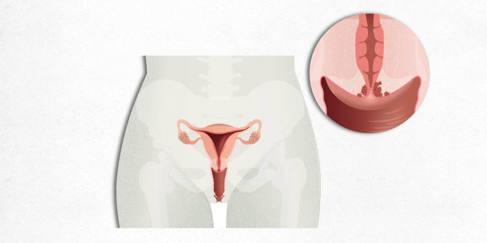 cáncer de cuello de útero