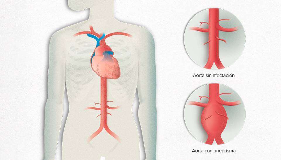 aneurisma de aorta