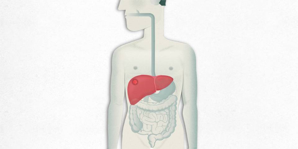 cáncer de hígado