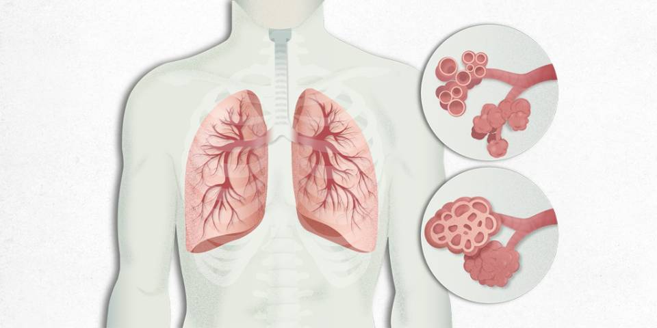 qué es la fibrosis pulmonar
