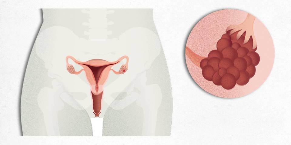 Anatomía del aparato reproductor femenino, tumor ovario, cáncer de ovarios