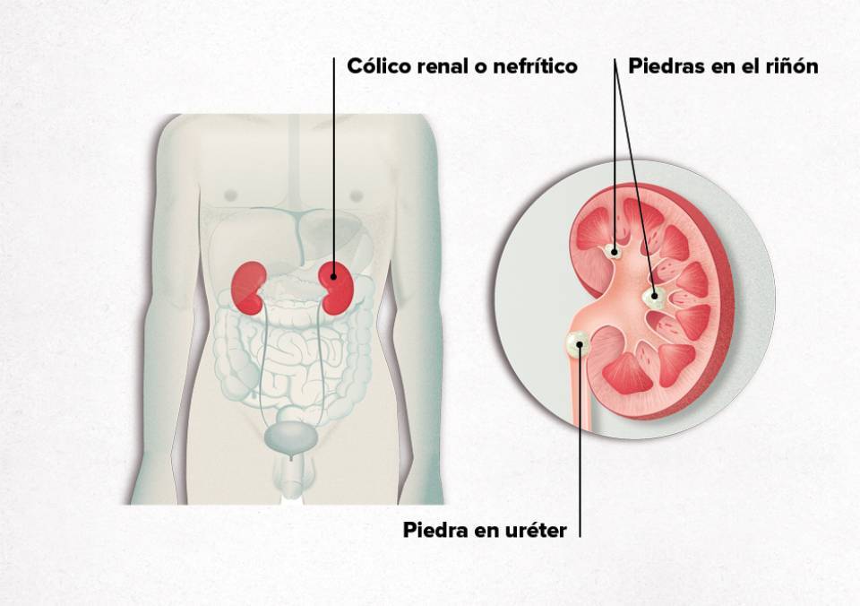 crecer escarabajo Día del Niño Litiasis Renal | Cálculos en el Riñón | PortalClínic