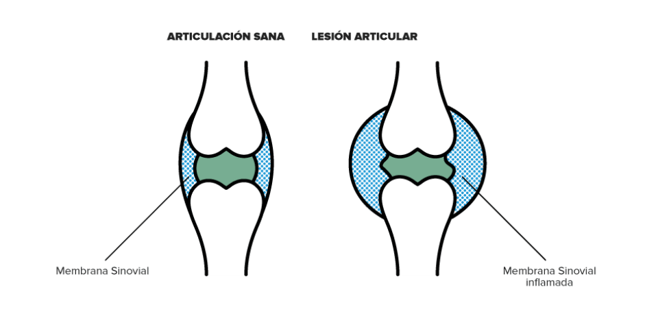 ¿Qué es la Artritis Reumatoide?