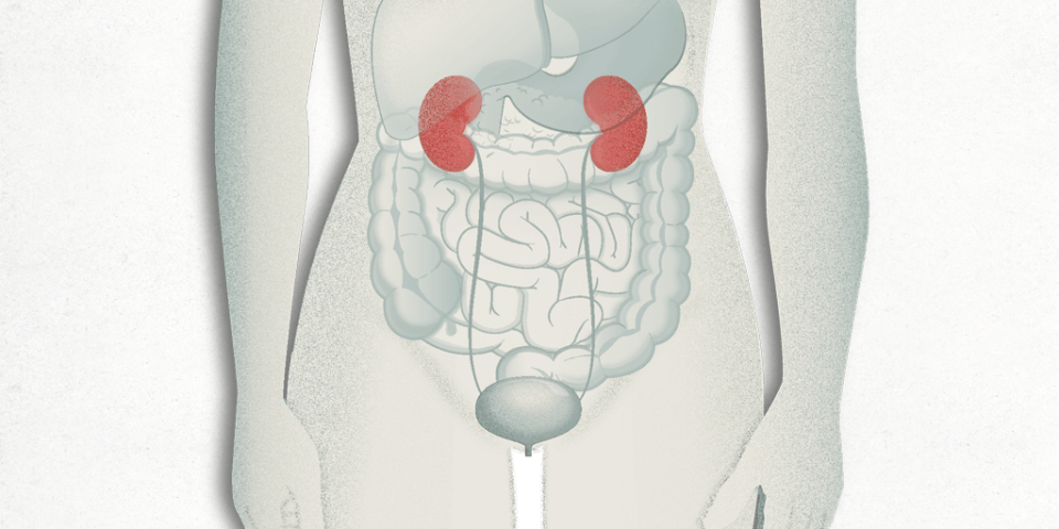 trasplante renal | trasplante de riñon
