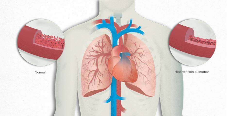 Hipertensión Pulmonar