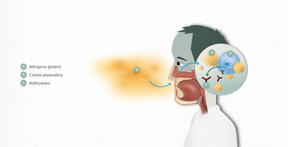 Qué es la alergia