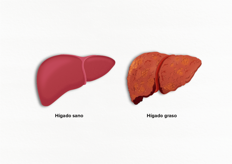 Comparación hígado sano vs. hígado graso