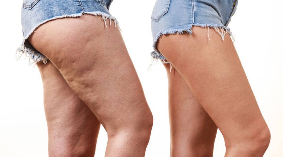 What is lipedema? All about the fat that's not your fault