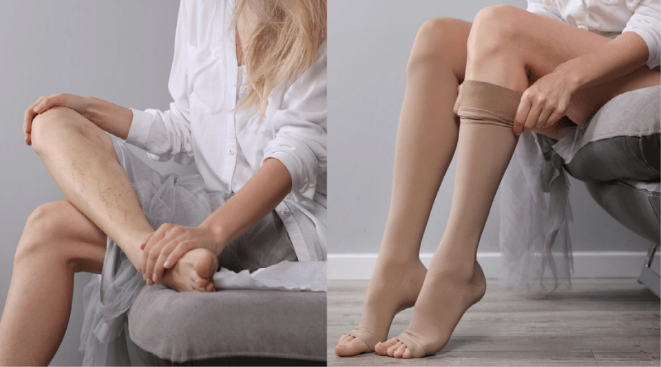 To improve varicose veins, there are also numerous pharmacological and non-pharmacological treatments available.