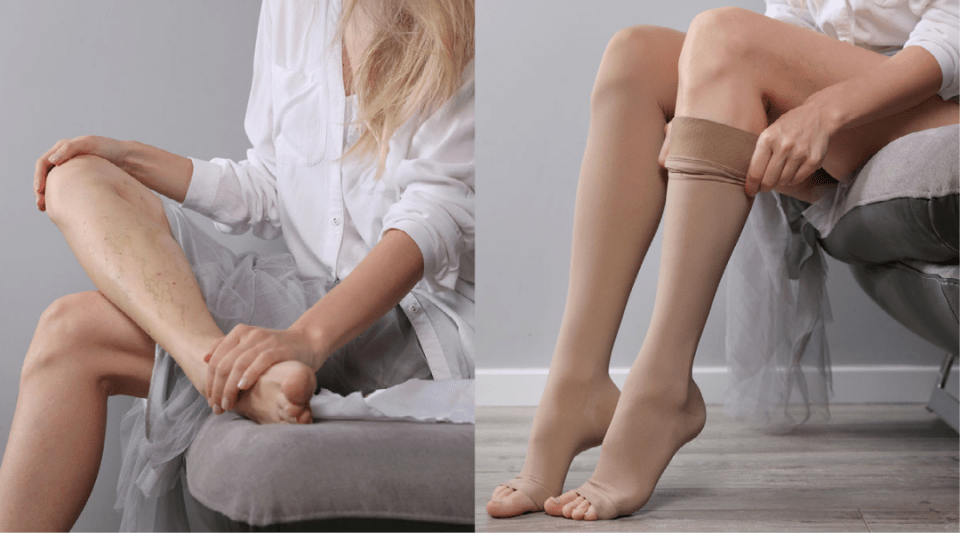 Living with varicose veins: tips to prevent the disease from progressing