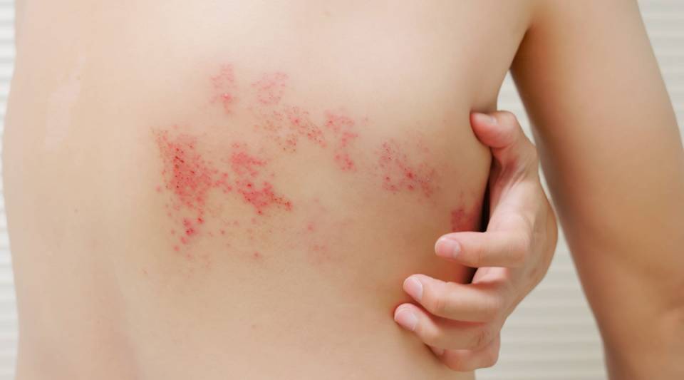 Herpes zoster: when the chickenpox virus reactivates after lying dormant