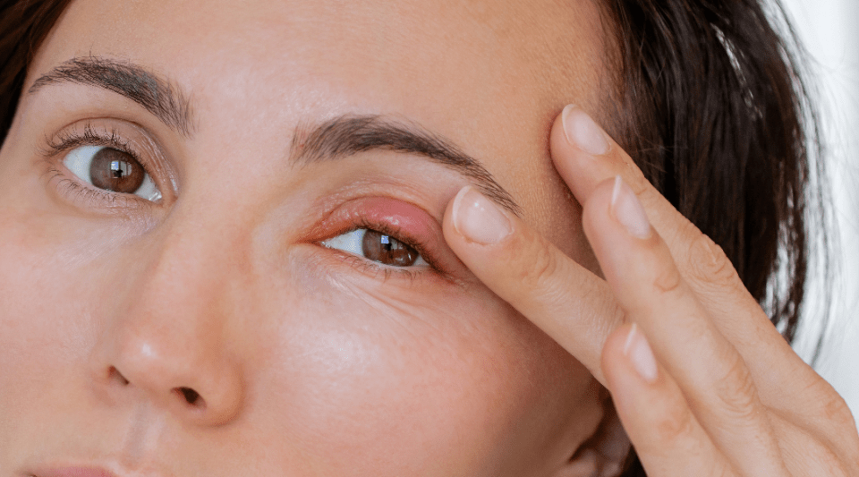 Eyelid disease