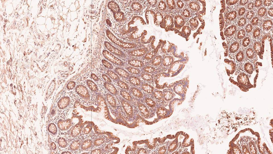 Tumor and Tissue Bank