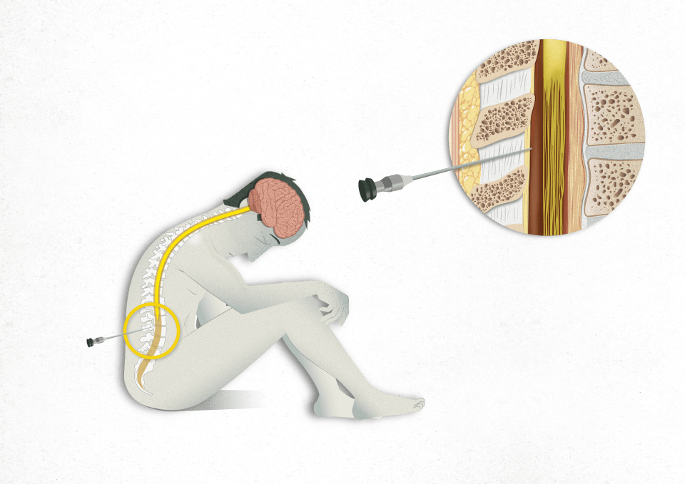 Lumbar Puncture, CSF, spinal cord