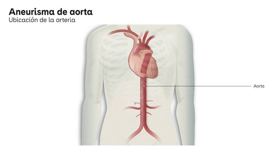 aneurisma de aorta
