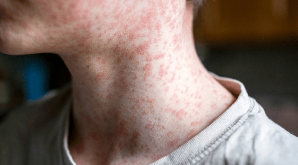 Zona del coll afectada pel virus del xarampió.