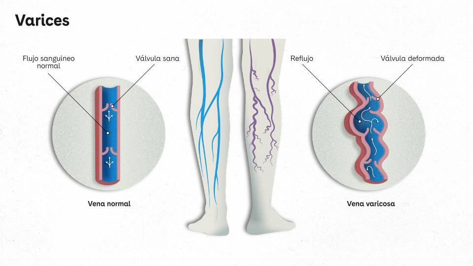 qué son las varices