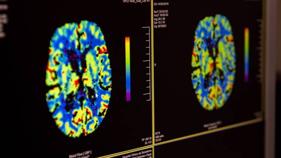 Ictus: el temps és cervell