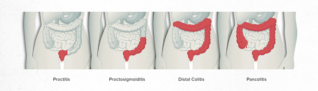 Nutricionista especialista en colitis ulcerosa