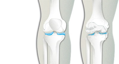 Artrosis de rodilla. Qué es, síntomas, diagnóstico y tratamiento. Clínica  Universidad de Navarra